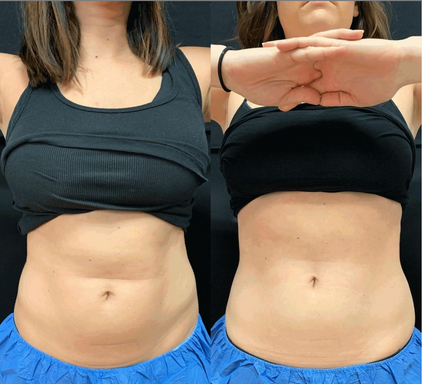 CoolSculpting Treatment Before + Afters | Rejuvenation MD Aesthetic | Asheboro, NC