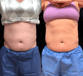 CoolSculpting Treatment Before + Afters | Rejuvenation MD Aesthetic | Asheboro, NC