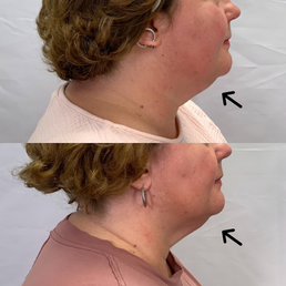 CoolSculpting Treatment Before + Afters | Rejuvenation MD Aesthetic | Asheboro, NC