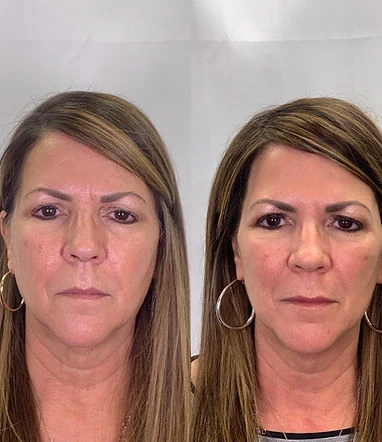 Full Facial Rejuvenation Before and After | Rejuvenation MD Aesthetic | Asheboro, NC