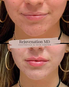 Lip Augmentation and Restoration Treatments | Rejuvenation MD Aesthetic | Asheboro, NC