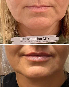 Lip Augmentation and Restoration Treatments | Rejuvenation MD Aesthetic | Asheboro, NC