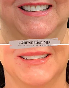 Lip Augmentation and Restoration Treatments | Rejuvenation MD Aesthetic | Asheboro, NC