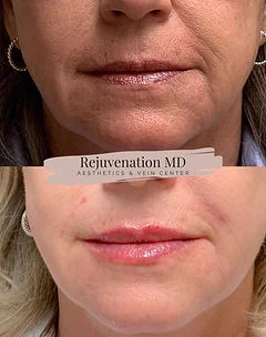 Lip Augmentation and Restoration Treatments | Rejuvenation MD Aesthetic | Asheboro, NC