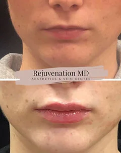 Lip Augmentation and Restoration Treatments | Rejuvenation MD Aesthetic | Asheboro, NC