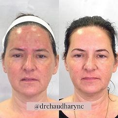 IPL PhotoFacial before after Treatment | Rejuvenation MD Aesthetic | Asheboro, NC