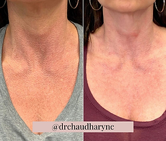 IPL PhotoFacial before after Treatment | Rejuvenation MD Aesthetic | Asheboro, NC