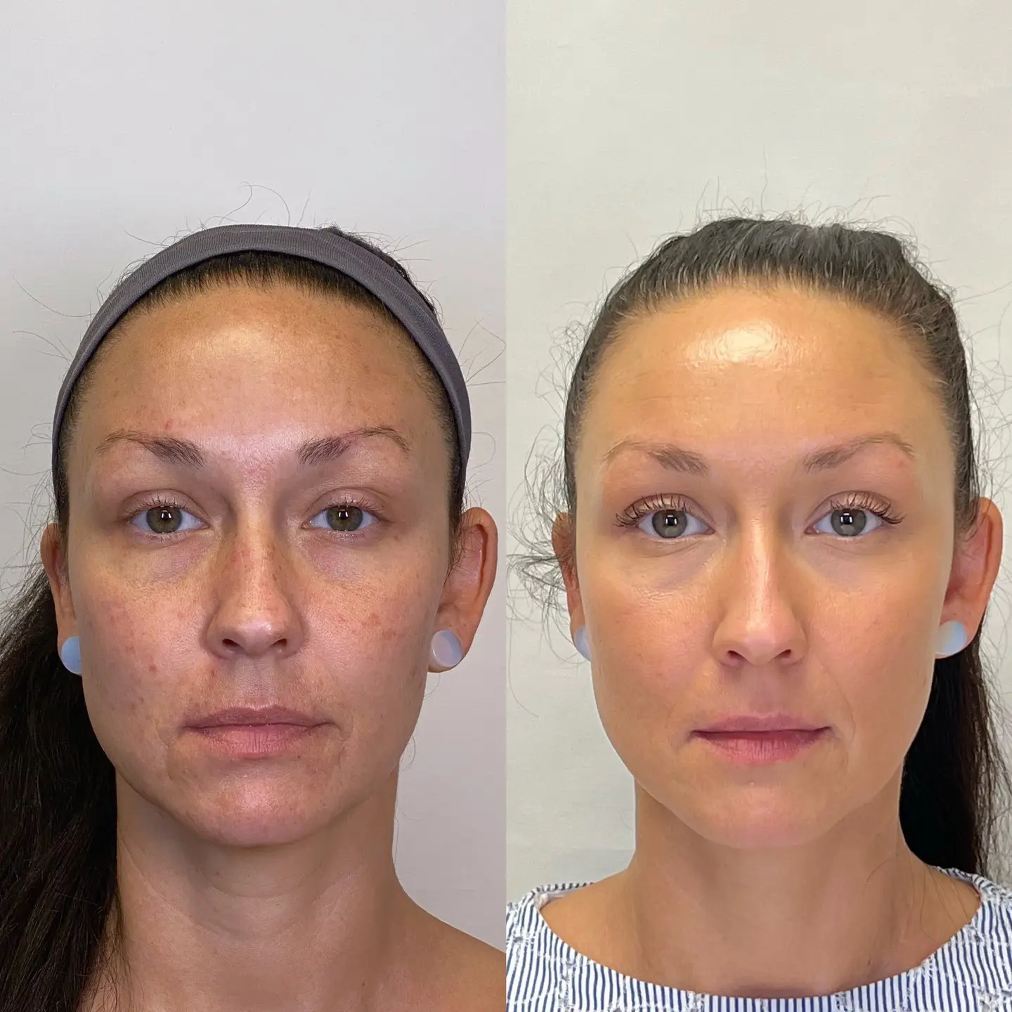 Chemical Peels | Rejuvenation MD Aesthetics & Vein Center | Asheboro, NC