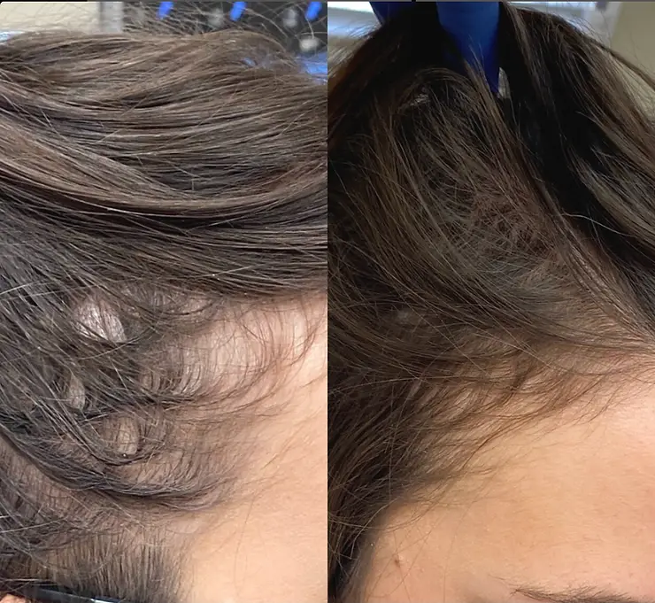 Before & After 1 PRP Hair Treatment, 4 weeks apart