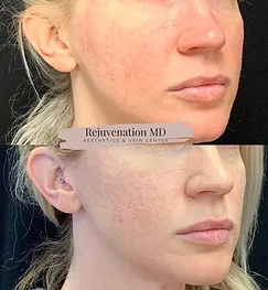 IPL PhotoFacial before after Treatment | Rejuvenation MD Aesthetic | Asheboro, NC