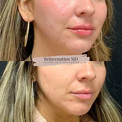 IPL PhotoFacial before after Treatment | Rejuvenation MD Aesthetic | Asheboro, NC