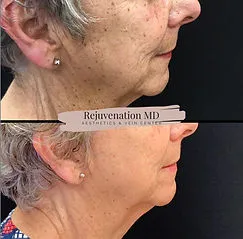 IPL PhotoFacial before after Treatment | Rejuvenation MD Aesthetic | Asheboro, NC