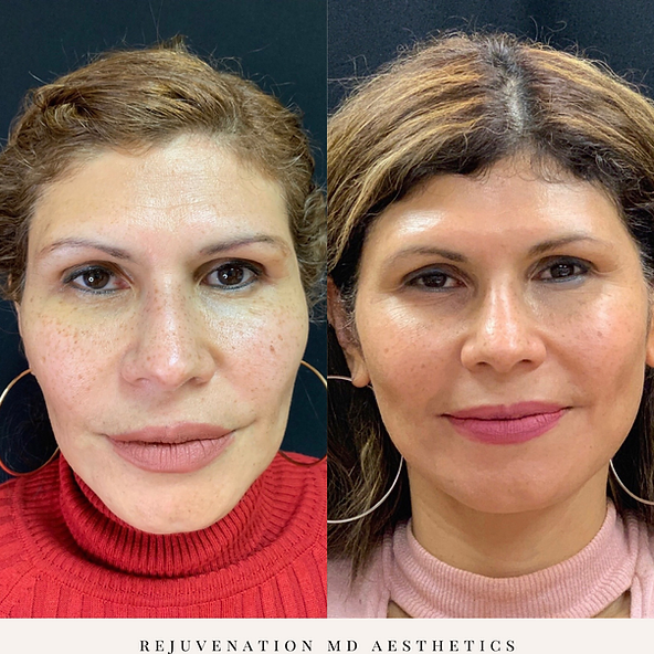 Before and after Sculptra Treatment | Rejuvenation MD Aesthetic | Greensboro, NC