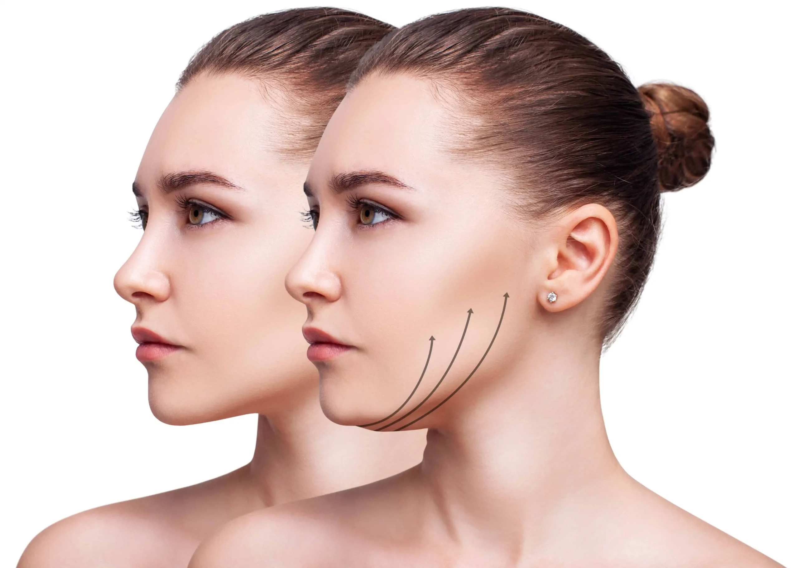 a woman with arrows on her chin | Rejuvenation MD | Asheboro | Greensboro, NC