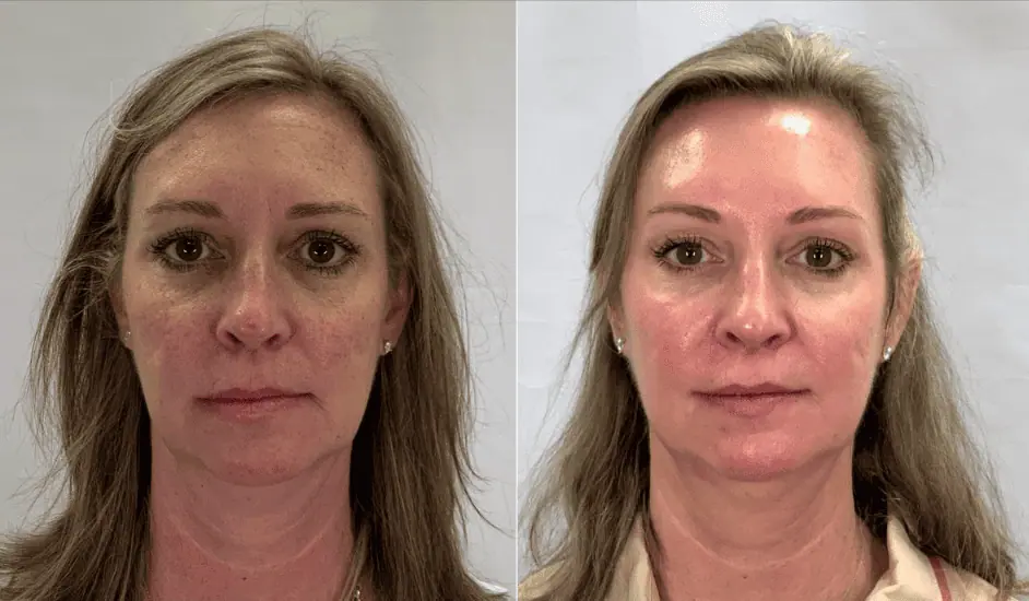 Before and After photo | Cyspera for Hyperpigmentation Treatment | Rejuvenation MD | Asheboro, NC