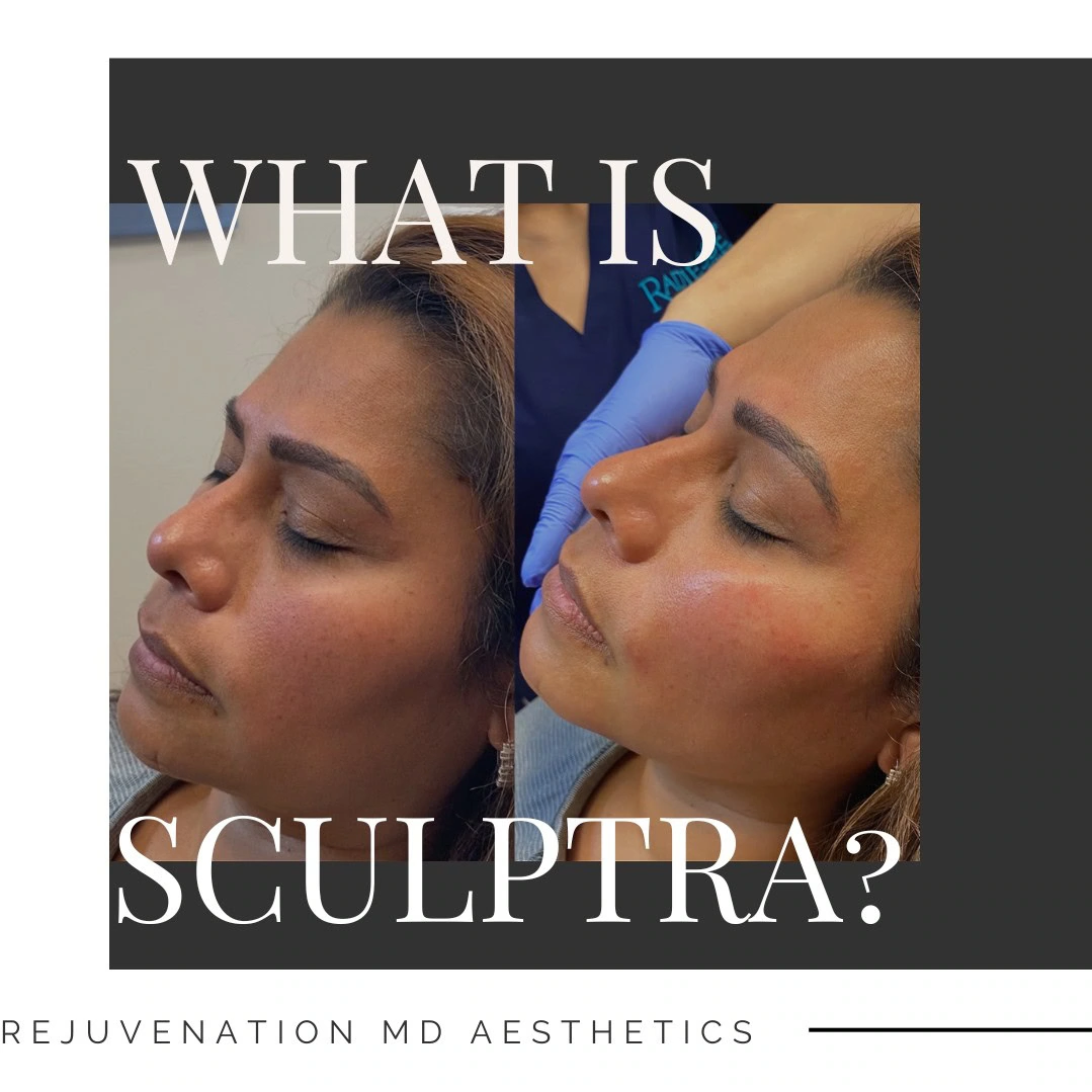 Sculptra for Ozempic Face | Rejuvenation MD | Asheboro, NC