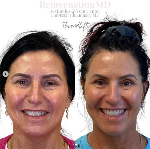 Before and After Image of Thread Lift | Rejuvenation MD | Greensboro and Asheboro