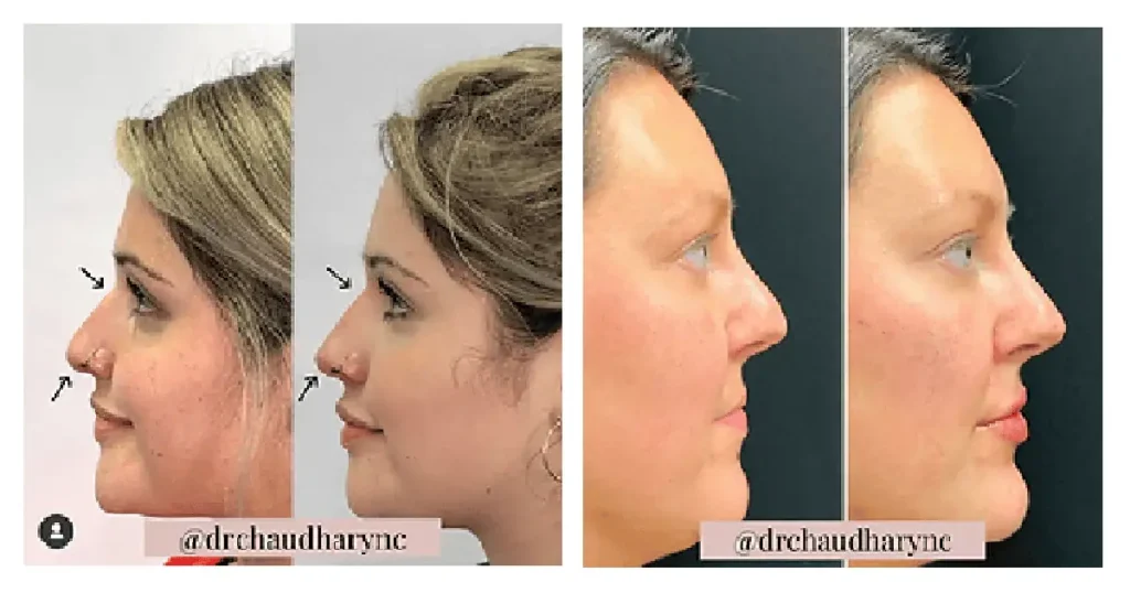 Non-Surgical Rhinoplasty in Asheboro and Greensboro by Rejuvenation MD