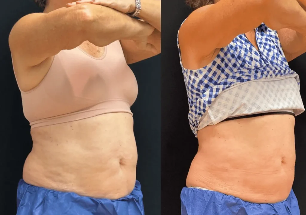Before and After Photo | Coolsculpting | Rejuvenation MD | Asheboro, NC