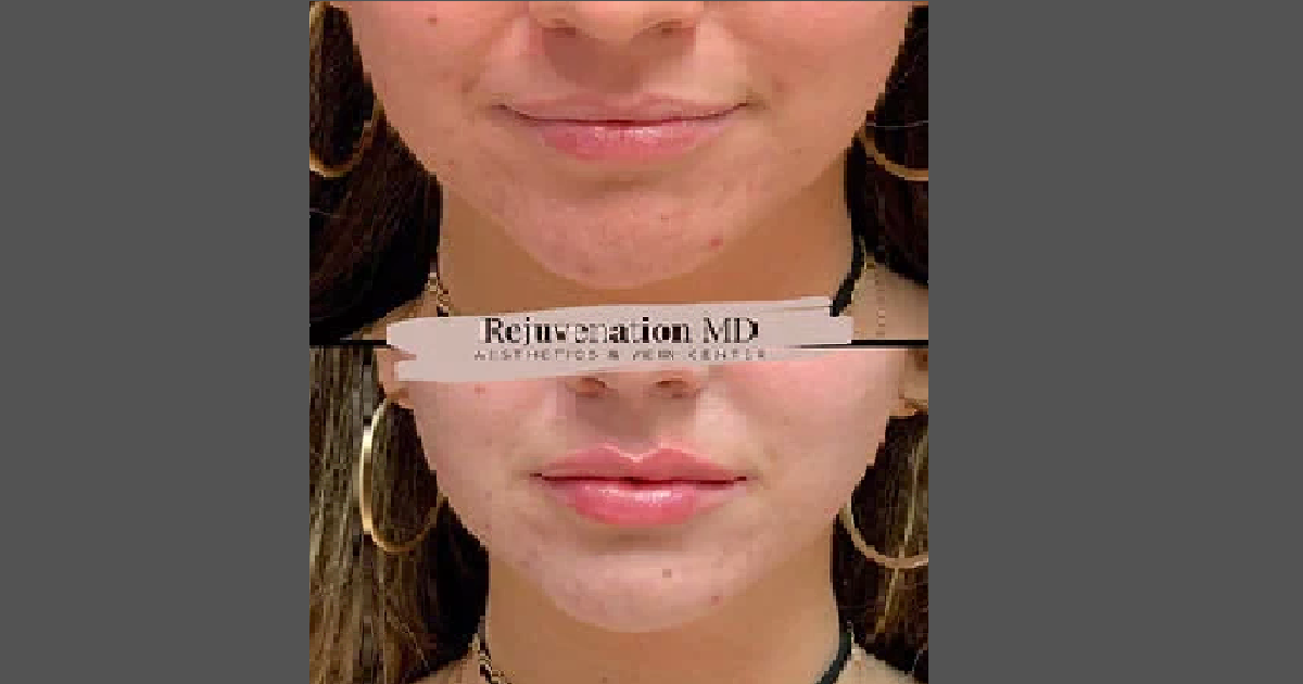 Lip Augmentation service by Rejuvenation MD in Greensboro, NC