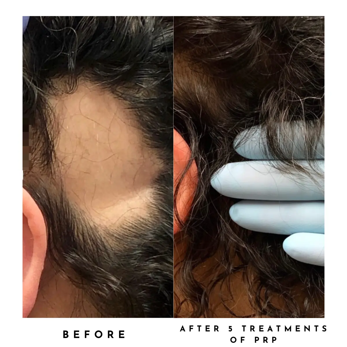 prp hair restoration