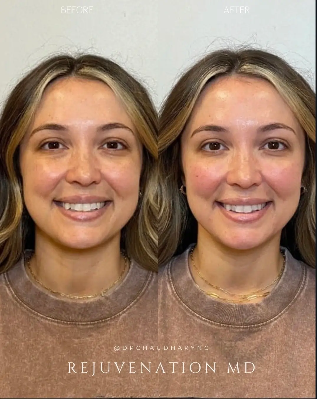 dermal filler treatment before and after