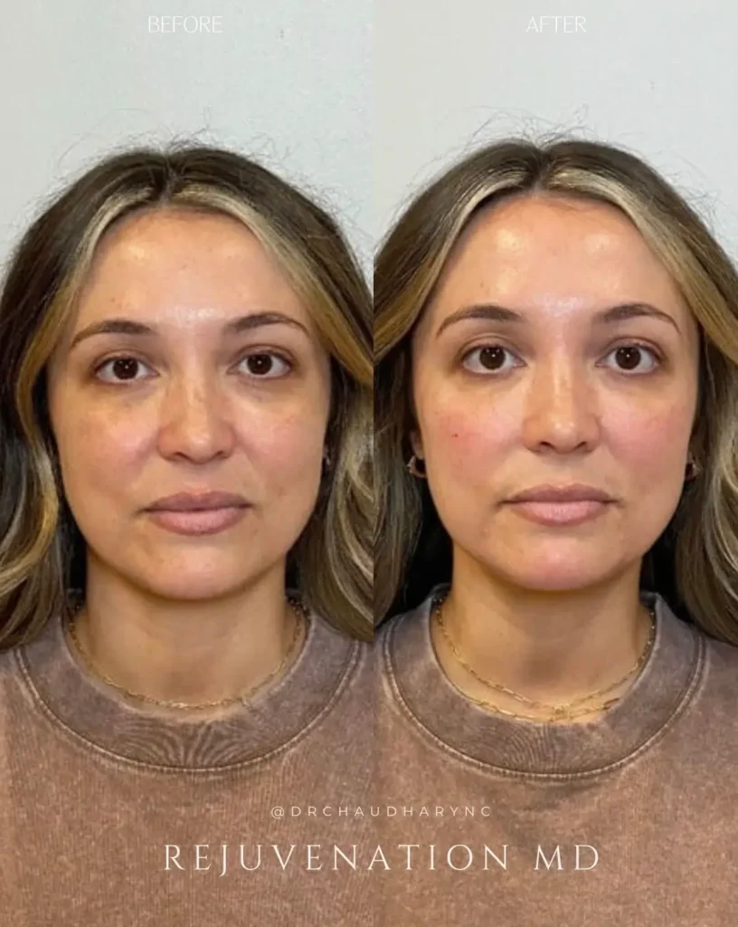 dermal filler women face before and after treatment