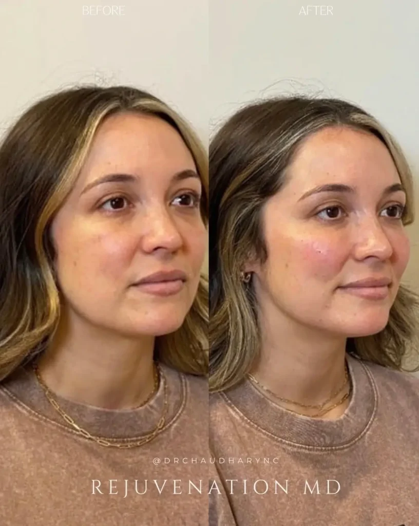 dermal filler before and after treatment women face