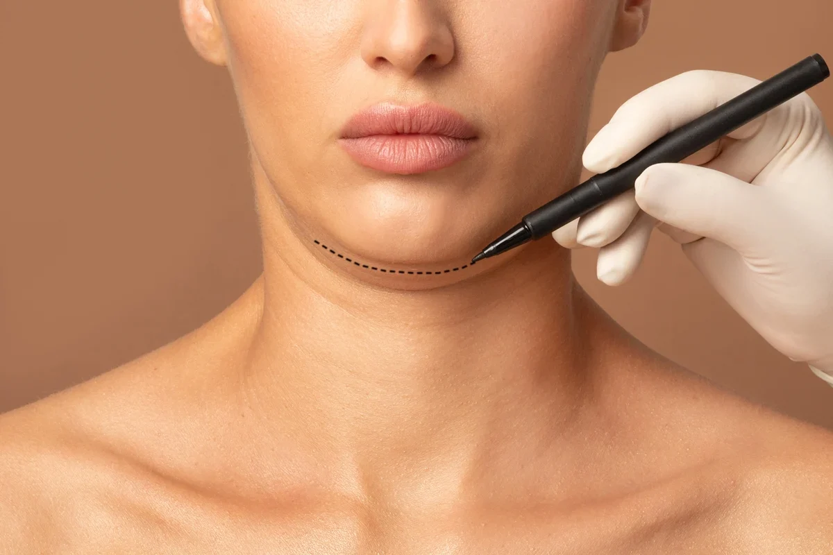 Double chin reduction treatment marking under the chin