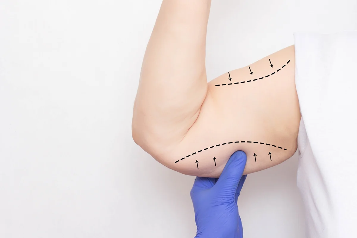Thermage skin tightening for sagging and loose skin
