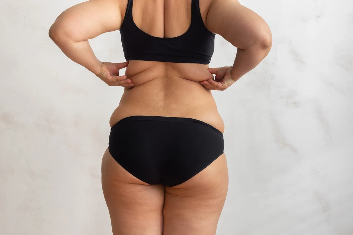 CoolSculpting for stubborn arm fat and bra fat