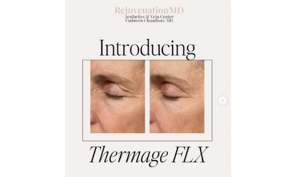 Thermage Skin Tightening by Rejuvenation MD in Asheboro SC