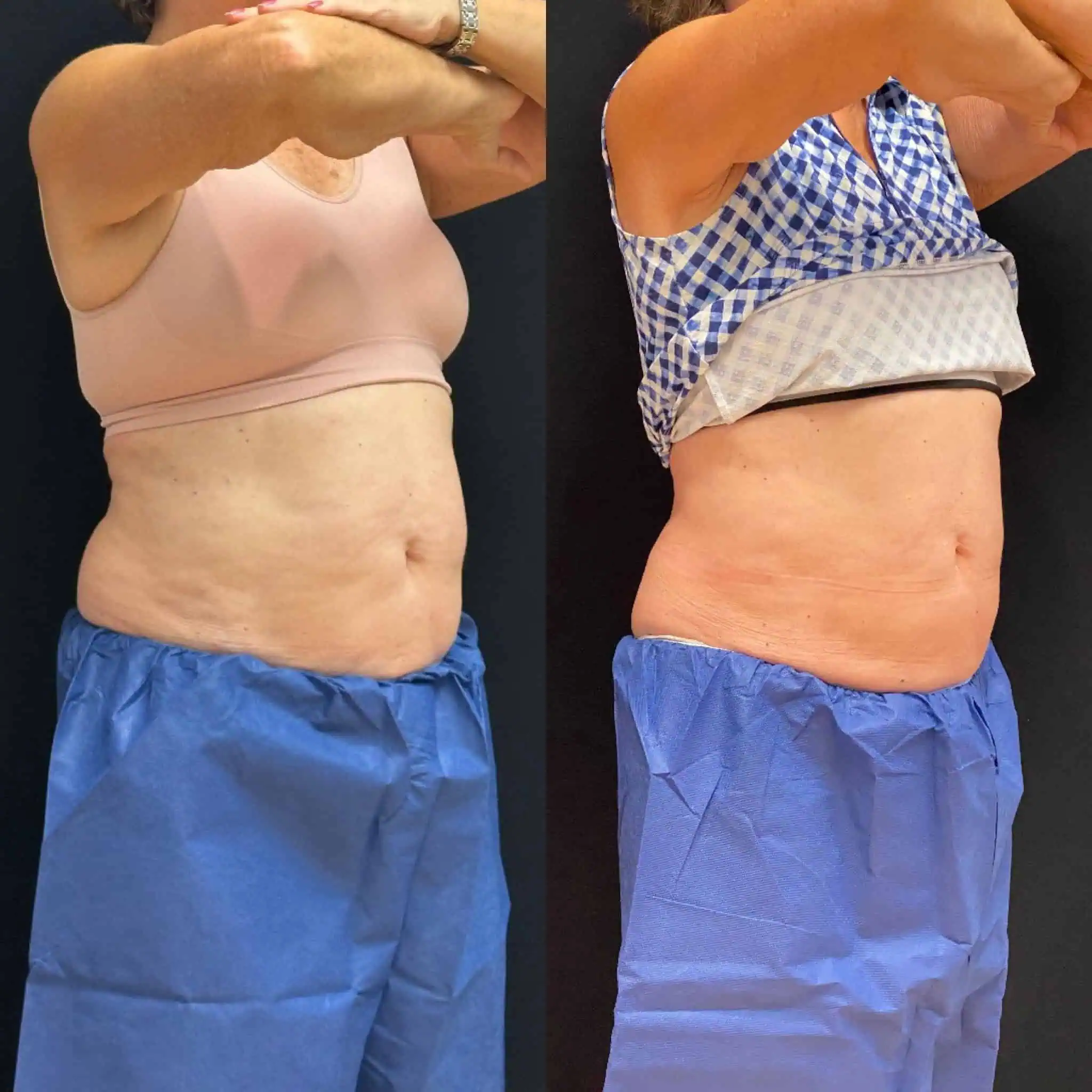 Coolsculpting treatment for love handles | before and after | Rejuvenation MD | Asheboro | Greensboro, NC