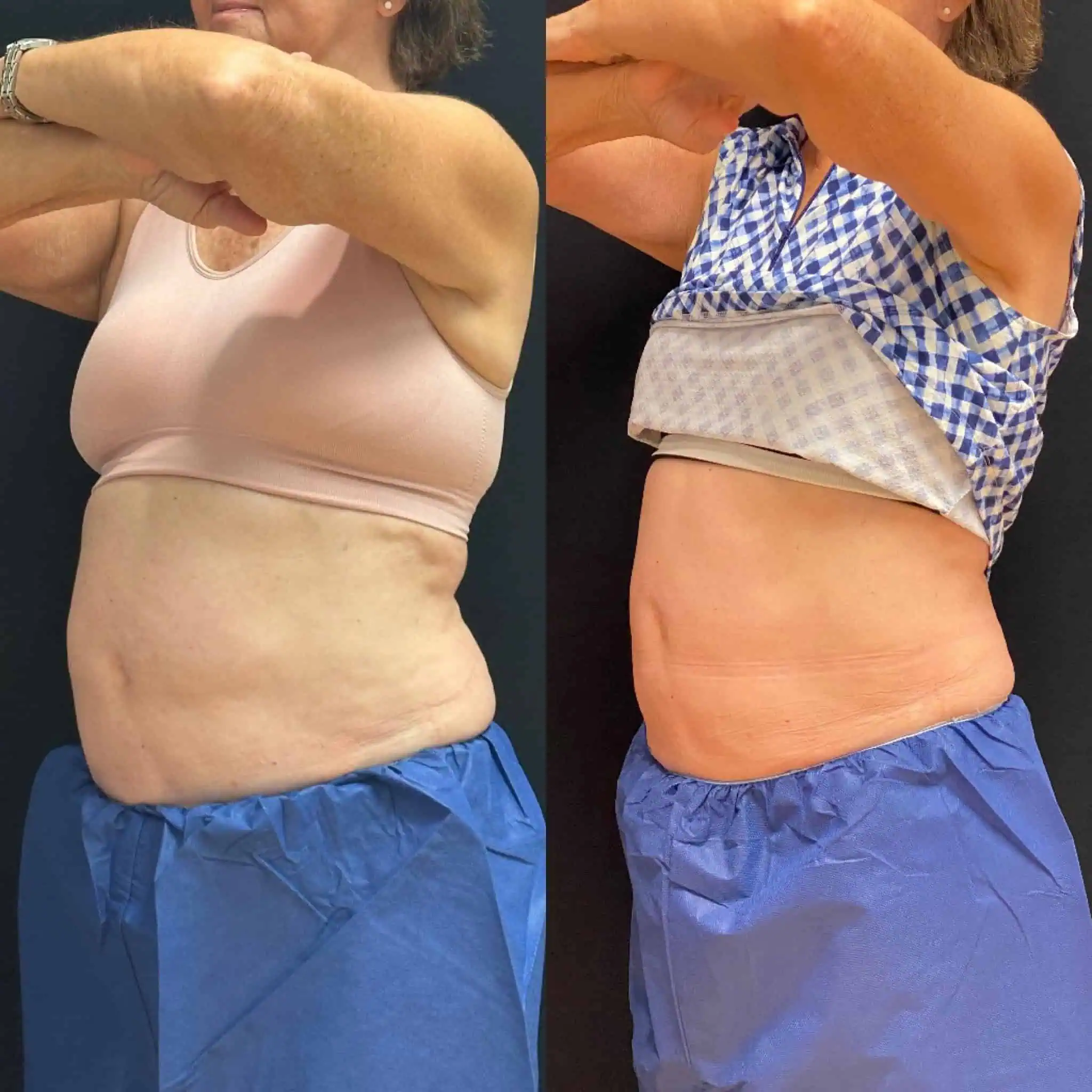 Coolsculpting treatment for fat loss | before and after | Rejuvenation MD | Asheboro | Greensboro, NC