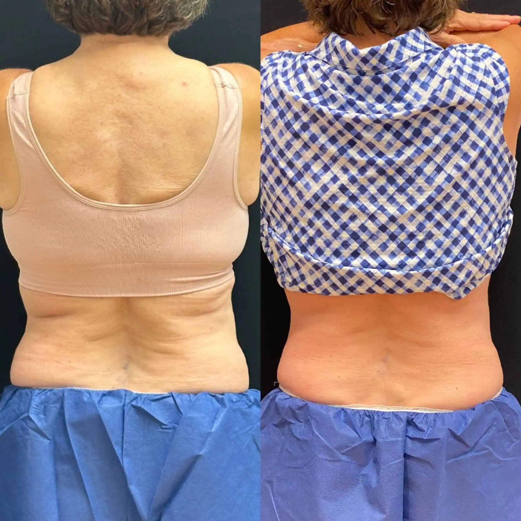 Coolsculpting treatment for back fat | before and after | Rejuvenation MD | Asheboro | Greensboro, NC