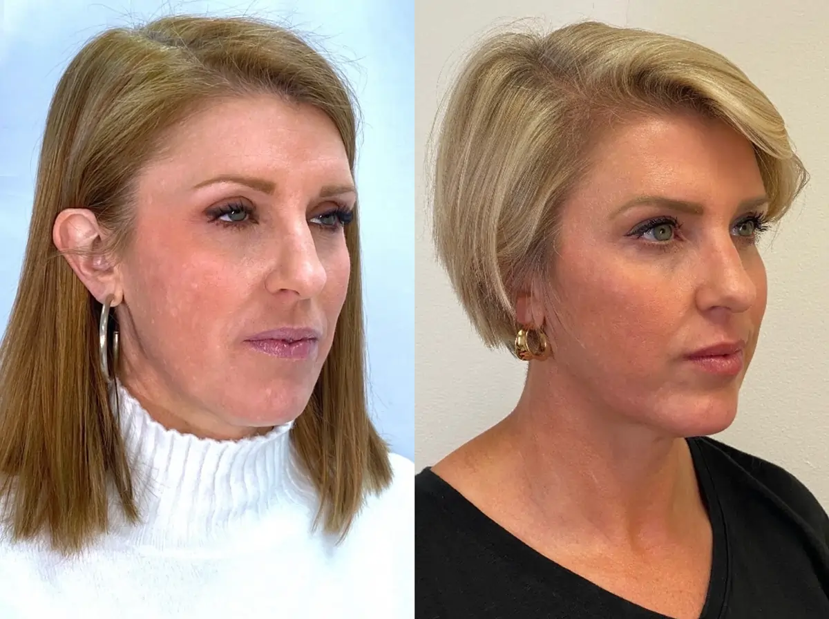 Women face: See Results After Sculptra Treatment